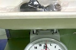 Lấy khối t&oacute;c nặng 250g khỏi bụng b&eacute; g&aacute;i 5 tuổi ở C&agrave; Mau