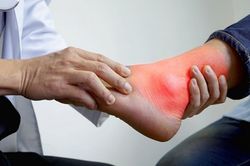 Chủ quan với đau khớp chân, thanh niên 20 tuổi ngỡ ngàng khi phát hiện mắc gout