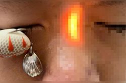 Bé trai 13 tuổi đi cấp cứu với lưỡi câu ghim sâu trong mắt