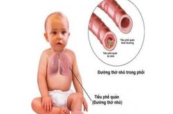 Viêm tiểu phế quản cấp ở trẻ cần phát hiện sớm