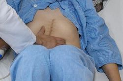 Từ một dấu hiệu lạ, phát hiện mắc cùng lúc ung thư trực tràng và phổi