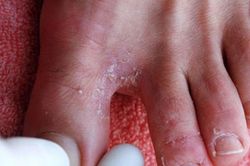 Bệnh ngoài da hay gặp mùa mưa bão