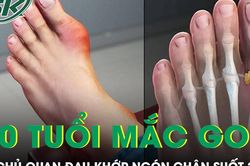 Đau khớp ngón chân suốt 2 năm nam thanh niên 20 tuổi mắc gout