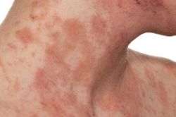 Ph&acirc;n biệt vi&ecirc;m da cơ địa với c&aacute;c bệnh da kh&aacute;c