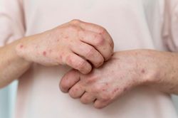 Mắc thủy đậu rồi có mắc lại lần hai không?