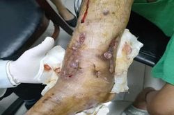 Suýt phải cắt chân sau nhiều lần phẫu thuật vì bỏ sót lao xương