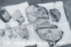 Tông đuôi xe container, nữ bệnh nhân thoát cửa tử sau 5 giờ phẫu thuật