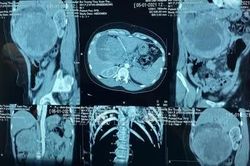 Mỹ phê duyệt thuốc điều trị ung thư tuyến tụy di căn