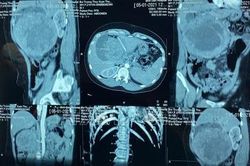 Mỹ ph&ecirc; duyệt thuốc điều trị ung thư tuyến tụy di căn