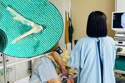 Xương ghẹ chắn ngang thực quản cụ ông 81 tuổi