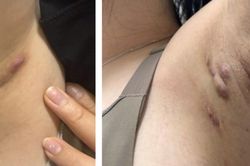 Vi&ecirc;m tuyến mồ h&ocirc;i mủ dễ nhầm với mụn nhọt, &aacute;p xe