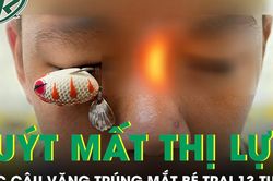 Móc câu văng trúng mắt, bé trai 13 tuổi suýt mất thị lực