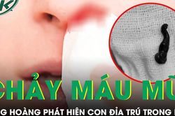 Chảy máu mũi suốt một tháng nam thanh niên phát hiện con đỉa trú trong mũi