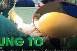 B&eacute; g&aacute;i 15 tuổi bụng to như tăng c&acirc;n, ph&aacute;t hiện khối u buồng trứng khổng lồ
