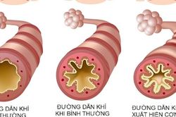 Ph&ograve;ng tr&aacute;nh cơn hen cấp l&uacute;c giao m&ugrave;a