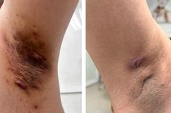 Ai dễ mắc vi&ecirc;m tuyến mồ h&ocirc;i mủ?