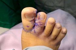 Bệnh viện II Lâm Đồng: Phẫu thuật thành công ca dị tật dính ngón chân bẩm sinh hiếm gặp