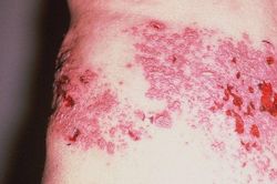 Loại virus tồn tại suốt đời khi đã mắc, có thể gây ra cơn đau dữ dội