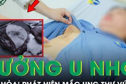 Tưởng chỉ là u nhỏ, người phụ nữ 'tá hoả' mắc ung thư vú