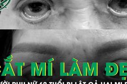 Biến chứng cắt mí thẩm mỹ, người phụ nữ 62 tuổi bị lật cả hai mi dưới