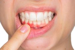 Chăm răng mỗi ngày vẫn sưng nướu: Có thể bạn đang mắc 8 sai lầm này