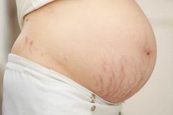 Rạn da sau sinh, đừng tin quảng cáo 'xóa rạn hoàn toàn'