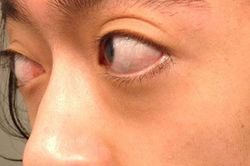 Lồi mắt Basedow cần làm gì?