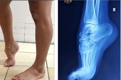 Phẫu thuật thành công ca dị tật 'bàn chân thuổng' bẩm sinh phức tạp