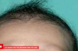 Bác sĩ Hàn Quốc phẫu thuật miễn phí cho trẻ mắc dị tật