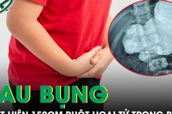 Nam sinh đau bụng, bác sĩ phát hiện 150 cm ruột hoại tử