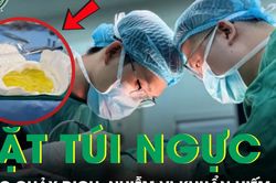 Đặt t&uacute;i ngực 2 lần, người phụ nữ 38 tuổi nhiễm vi khuẩn hiếm gặp