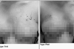 Ngực biến dạng, áp xe nặng sau khi tiêm filler tại nhà