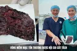 Rối loạn tiêu hóa phát hiện tổn thương tiền ung thư trực tràng