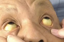 Vàng da, men gan tăng 30 lần sau 6 tuần uống thuốc Bắc không rõ nguồn gốc