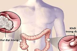 Ung thư đại trực tràng thường di căn đến đâu?