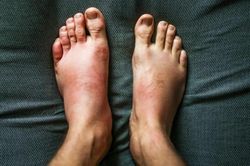 Cơ thể xuất hiện dấu hiệu này, coi chừng thận đang suy yếu