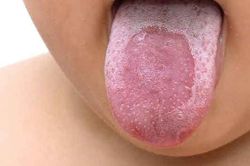 Những yếu tố làm tăng nguy cơ mắc lưỡi bản đồ