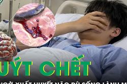 Chàng trai 23 tuổi bất ngờ liệt nửa người, xuất huyết não suýt chết