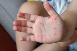 Bệnh tay chân miệng tăng khi trẻ trở lại trường