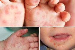 Gần 100.000 ca tay chân miệng: Trẻ trở lại trường, nguy cơ lây lan tăng
