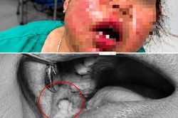 Từ đau răng đến áp xe vùng mặt: Cảnh báo nguy cơ nhiễm trùng ở người đái tháo đường