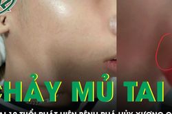 Bé 12 tuổi chảy mủ tai hôi, phát hiện bệnh phá hủy xương chũm