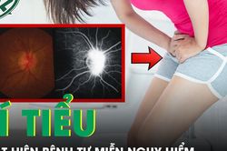 Bí tiểu kéo dài, người phụ nữ phát hiện bệnh tự miễn nguy hiểm