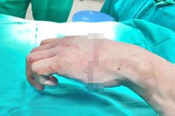 Bàn tay gần đứt lìa, nam thanh niên 21 tuổi cử động được các ngón sau vi phẫu