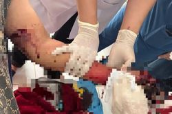 Điện thoại phát nổ khi đang sạc, thiếu niên 16 tuổi bị nát bàn tay