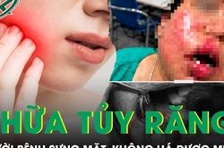 Sau điều trị tủy răng, người bệnh đái tháo đường sưng mặt, không há được miệng