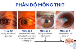 Mộng thịt khi nào cần phẫu thuật?