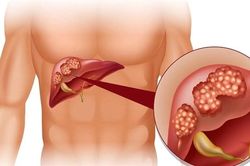 Khuyến cáo tổn thương gan cấp do sử dụng thuốc đông y không rõ nguồn gốc