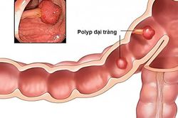 Polyp đại tràng được chẩn đoán như thế nào?