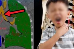 Bé 6 tuổi viêm phổi tái phát, bác sĩ tìm thấy thứ không ngờ trong phế quản